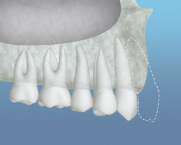 Inadequate Bone