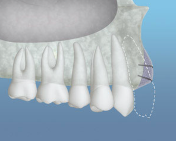 Graft Material Placed
