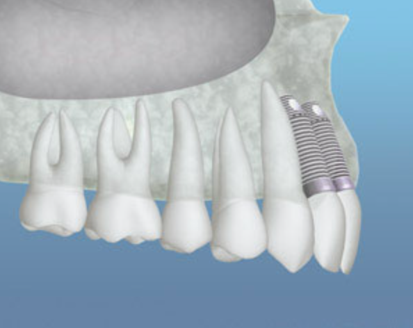 Implants Placed
