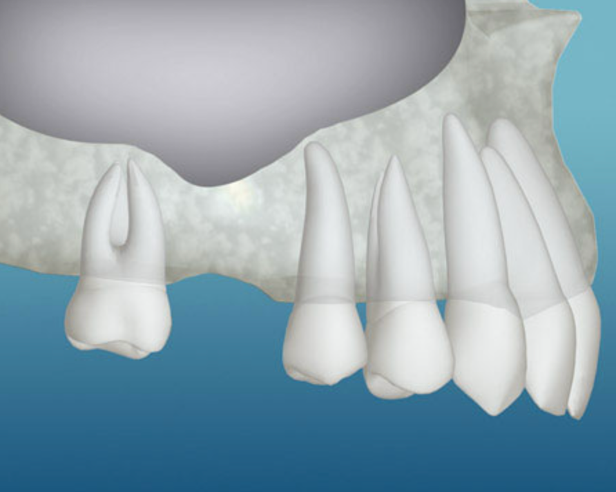 Inadequate Bone