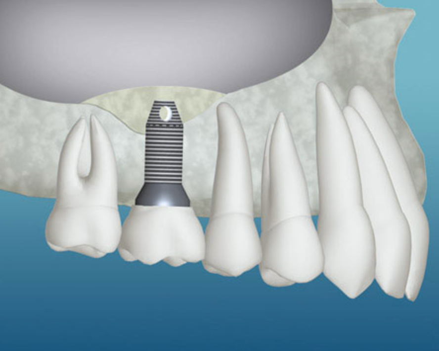 Graft Material and Implant Placed