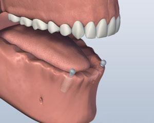 Implants Placed