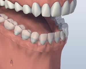 Denture Attached
