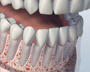 Implants Placed