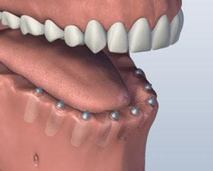 Implants Placed