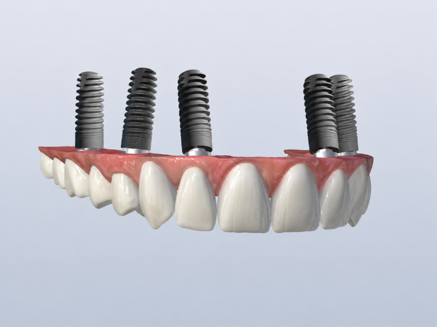Implant retained upper denture showing multiple implants supporting a removable prosthetic arch