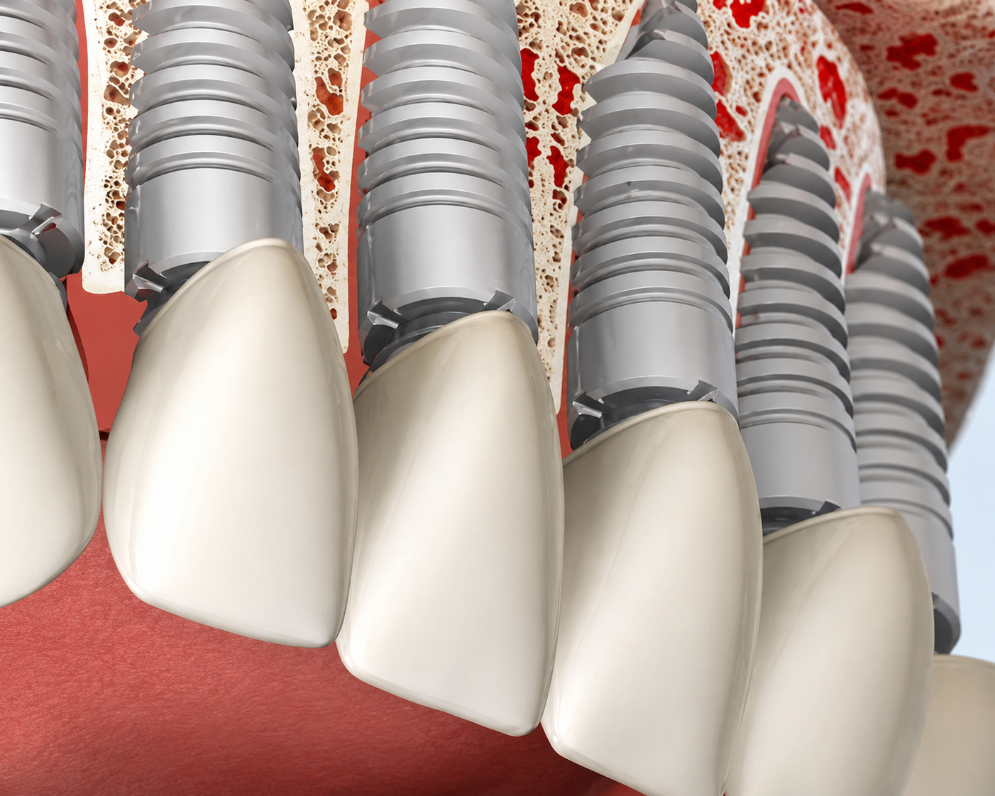 Individual upper implants showing multiple implants placed in the upper jaw with crowns