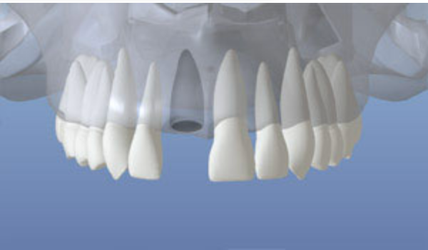 3D illustration showing a gap in the jaw after tooth loss