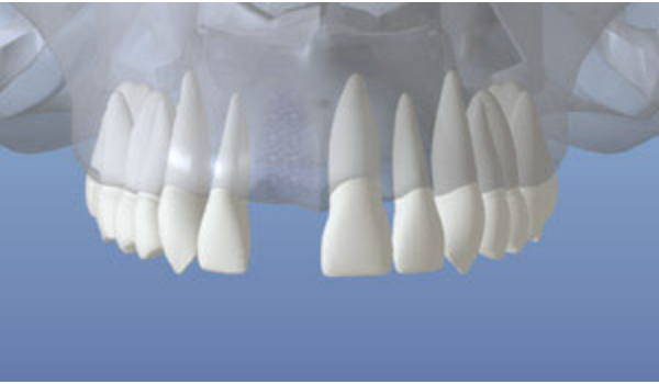 3D illustration showing healed bone in the jaw after tooth loss
