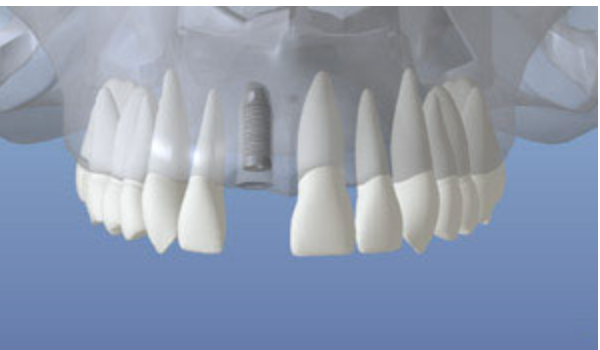 3D illustration of a titanium implant post placed in the jawbone