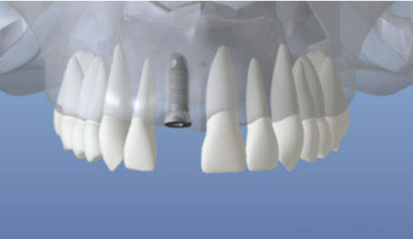 3D illustration showing the healing phase after implant placement
