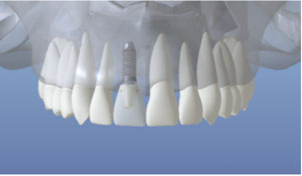 3D illustration of a fully restored dental implant with crown