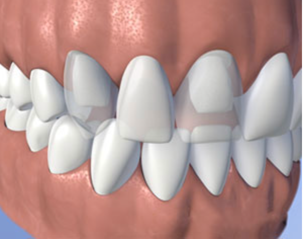 Illustration of a fixed dental bridge restoration