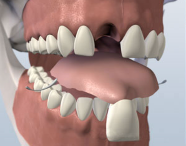 Illustration of a removable flipper partial denture