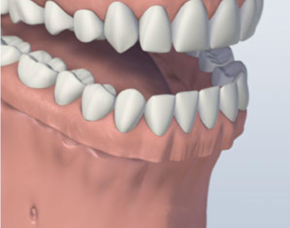 Illustration showing dental implants as a denture alternative