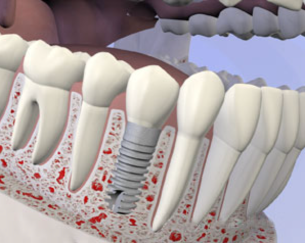 Cross-section illustration of a dental implant screw in the jawbone
