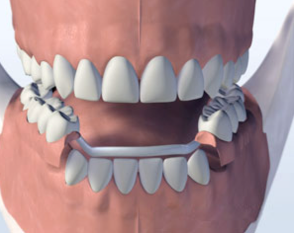 Illustration of a metal partial denture with wire clasps