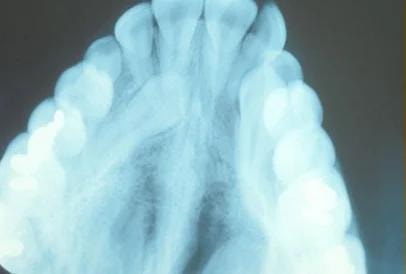 X-ray showing impacted eyetooth position