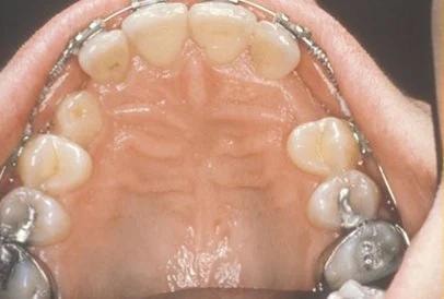 Orthodontic braces with space opened for impacted eyetooth
