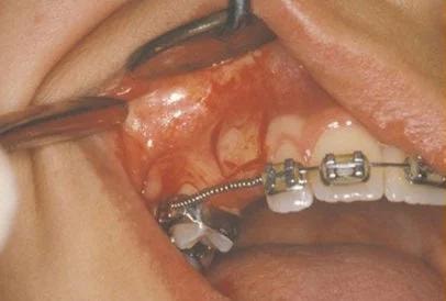 Surgical exposure of impacted eyetooth with bracket placement
