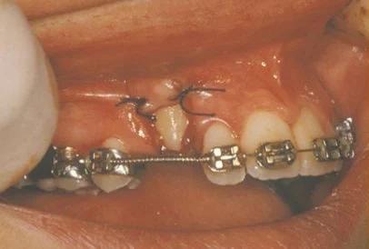 Bracket and chain bonded to exposed impacted tooth