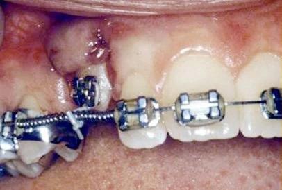 Orthodontic traction guiding impacted tooth into position