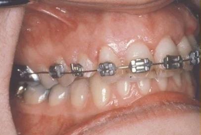 Final result after impacted eyetooth has erupted into position