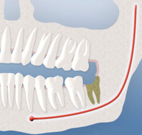 Diagram depicting a dry socket that developed after wisdom teeth removal