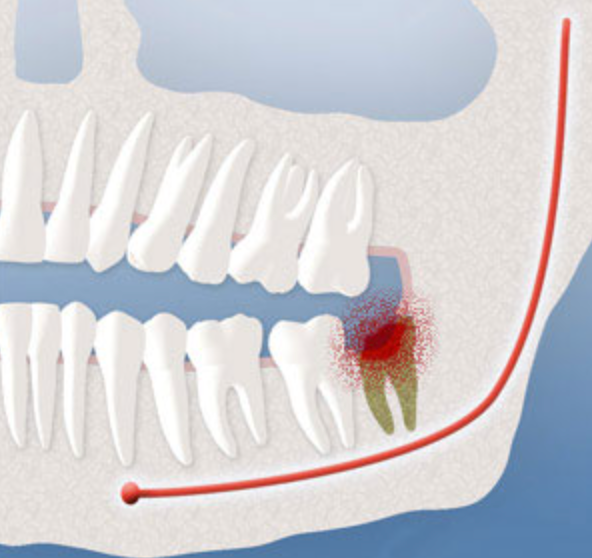 Medical illustration showing dental infection at the site of an impacted wisdom tooth