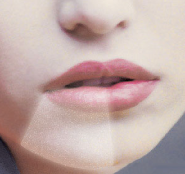 Close-up showing numbness area on lower lip and chin caused by sensory nerve damage