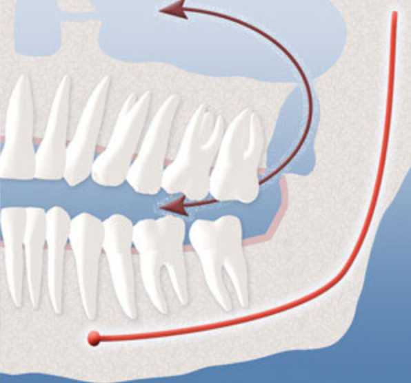 Diagram showing the opening that can occur between the mouth and sinuses after upper wisdom tooth removal