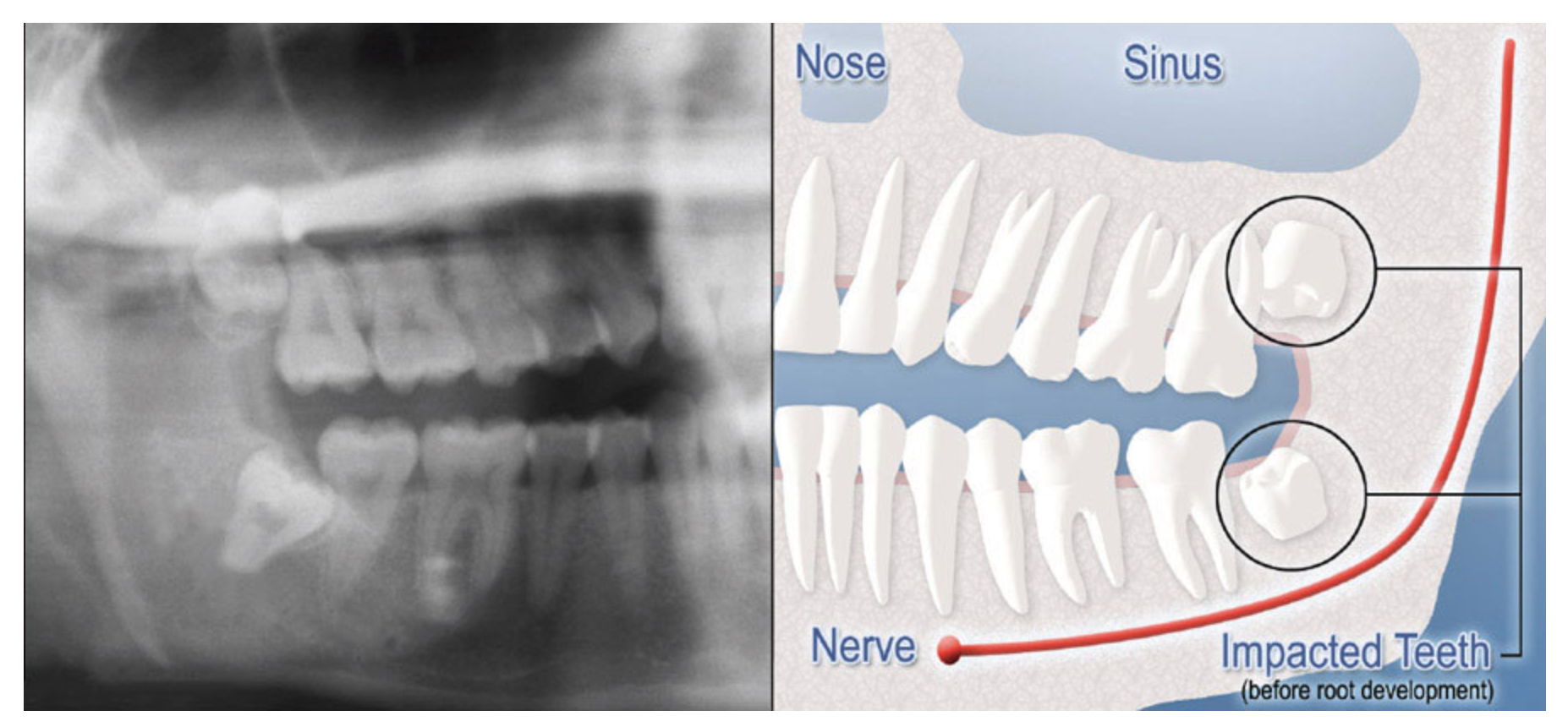 Panoramic X-ray alongside a diagram highlighting impacted wisdom teeth, showing the nerve, sinus, and tooth positions before root development
