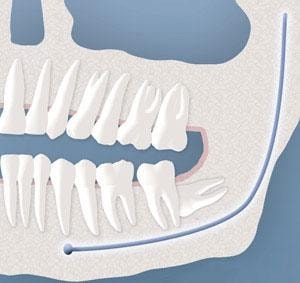 Diagram of complete bony wisdom tooth impaction