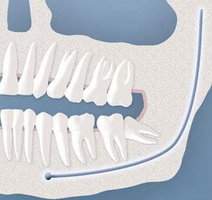 Diagram of partial bony wisdom tooth impaction
