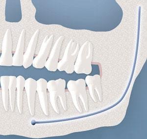 Diagram of soft tissue wisdom tooth impaction