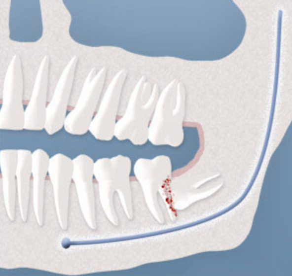 Illustration of an impacted wisdom tooth damaging the adjacent second molar