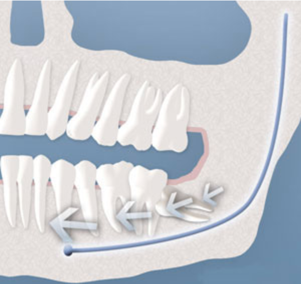 Illustration showing tooth crowding caused by an impacted wisdom tooth