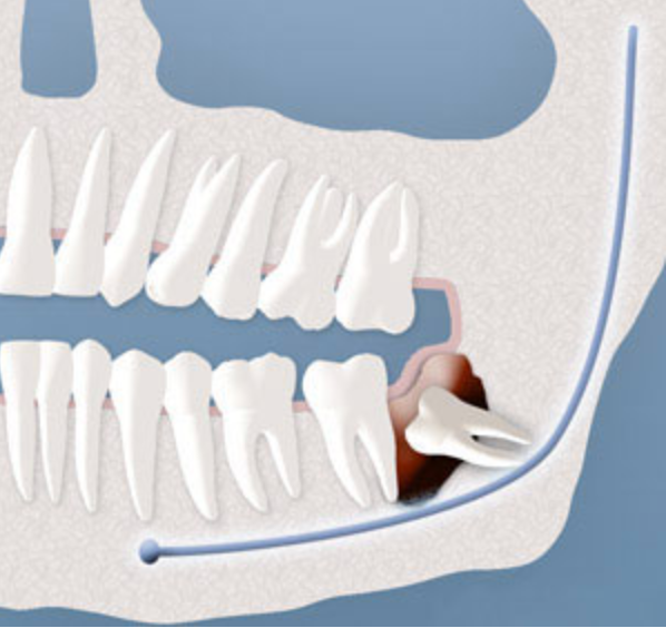 Illustration of cyst formation around an impacted wisdom tooth