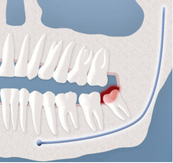Illustration of pericoronitis infection around an impacted wisdom tooth